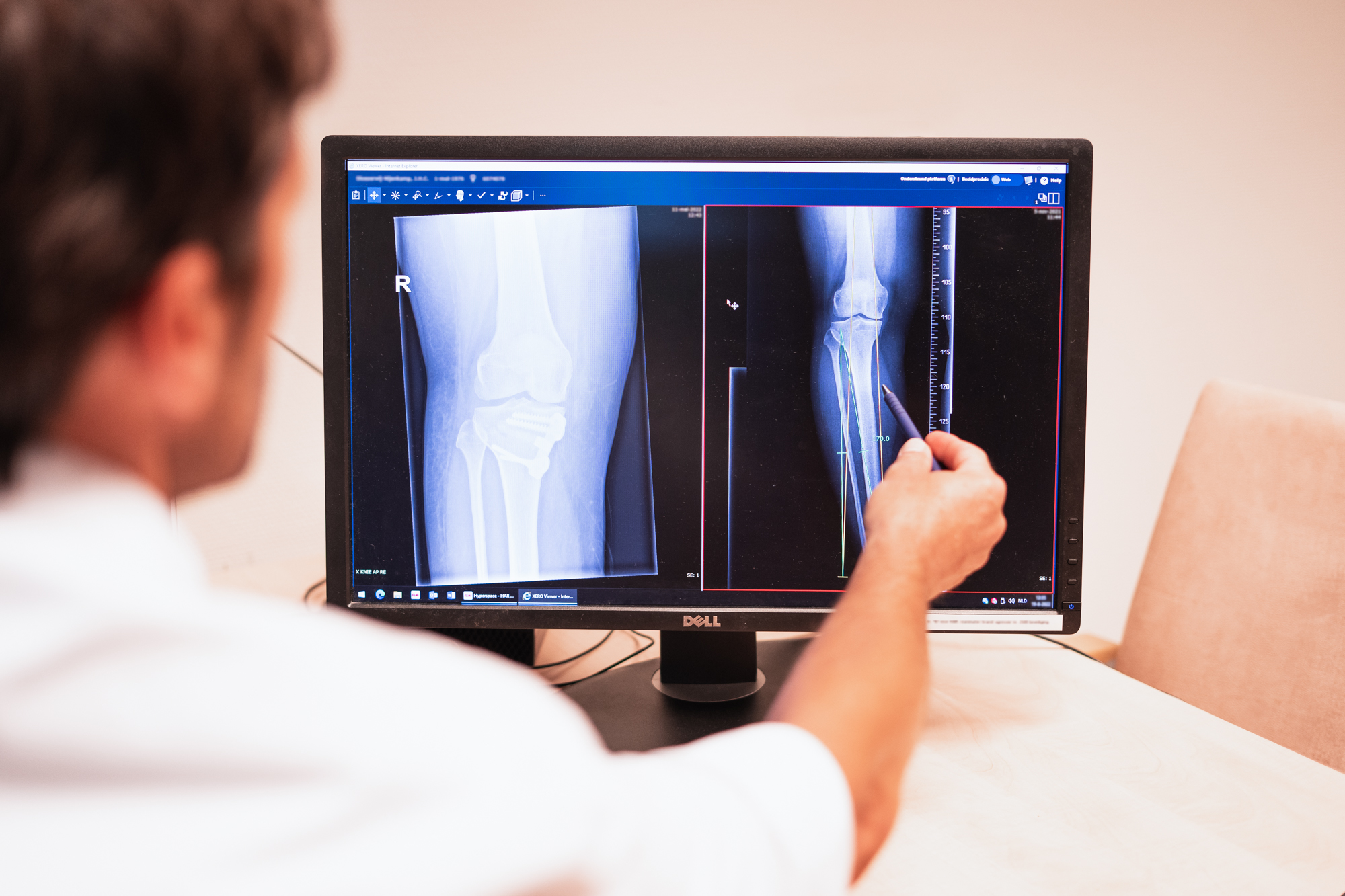 Informatieavond over knie- en heupartrose