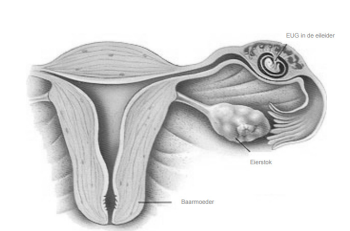 buitenbaarmoederlijke zwangerschap symptomen